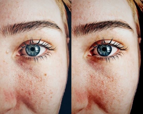 Vorher-Nachher Beispiel Digitale Schönheitskur